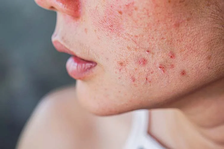 Roaccutane Consult