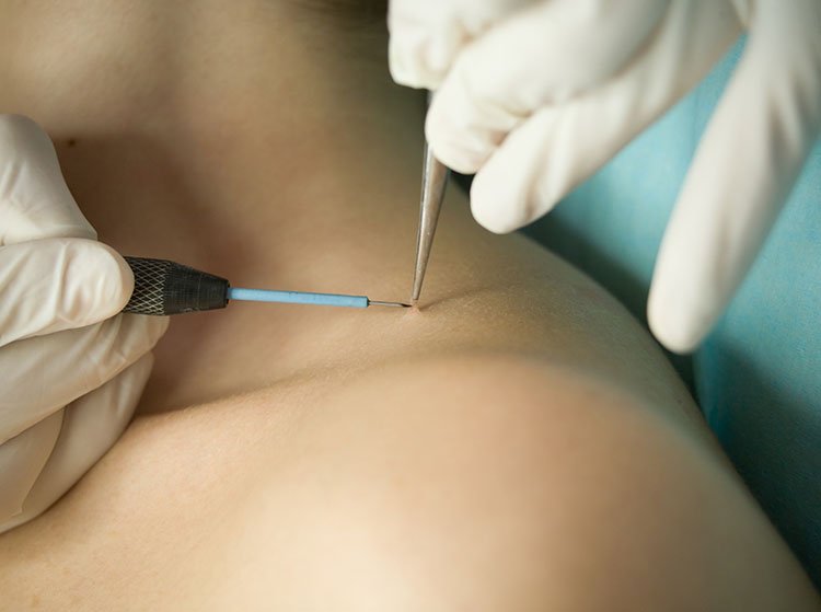 Wart Removal