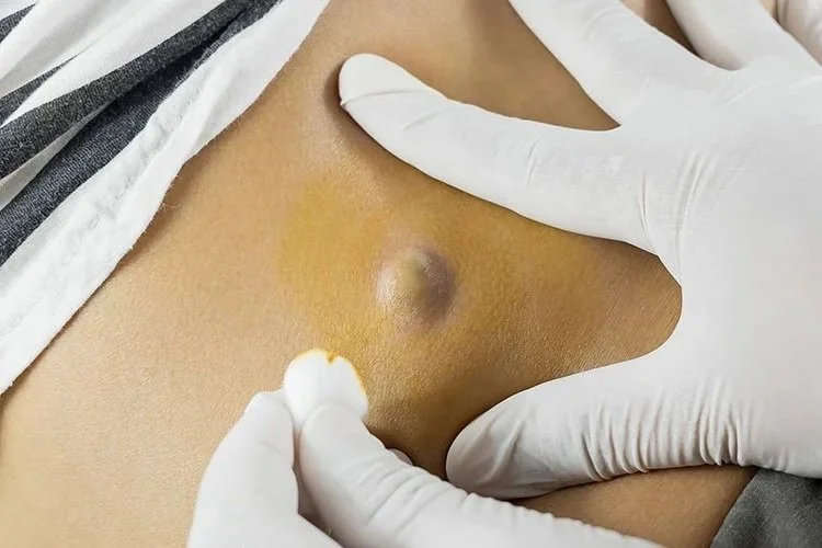 Cyst Removal