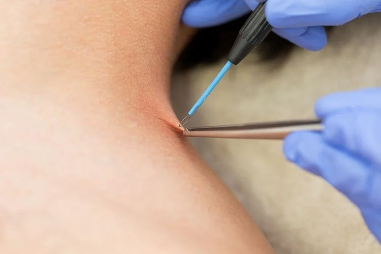 Lesion Removal