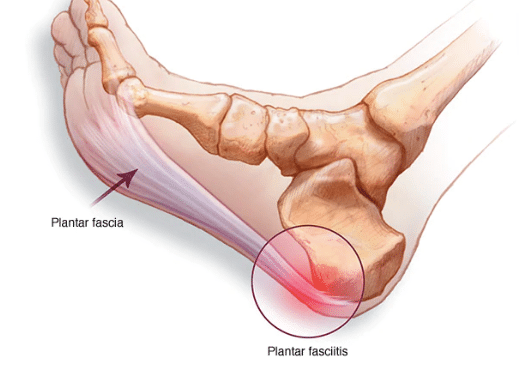 Plantar Fasciitis in Runners: What It Is, Why It Lingers, and How to Actually Get Rid of It