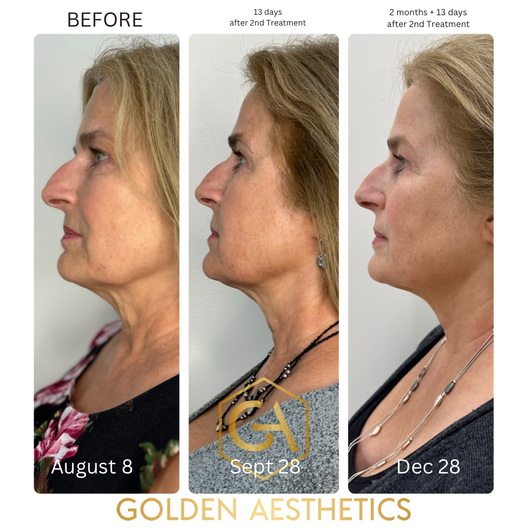 Client undergoing Total Skin Solution treatment combining radio frequency microneedling and laser facial at Golden Aesthetics in Newtown, CT