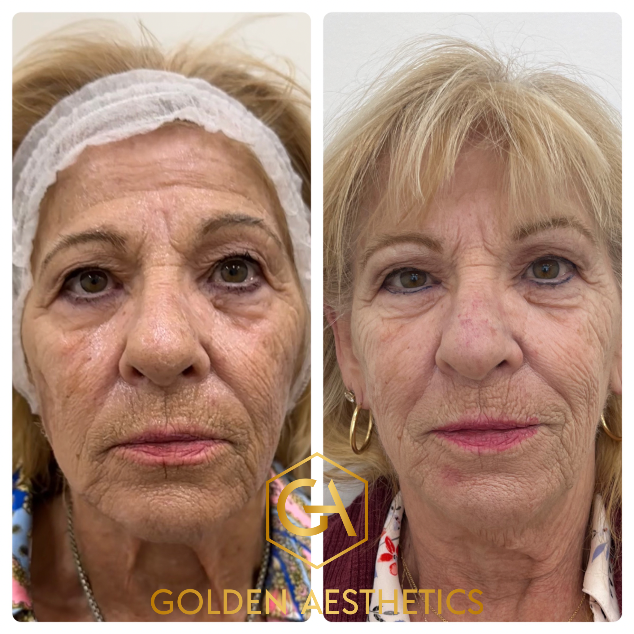 Patient who saw significant results from rf micro needling + laser facial. Brighter skin and improved laxity.