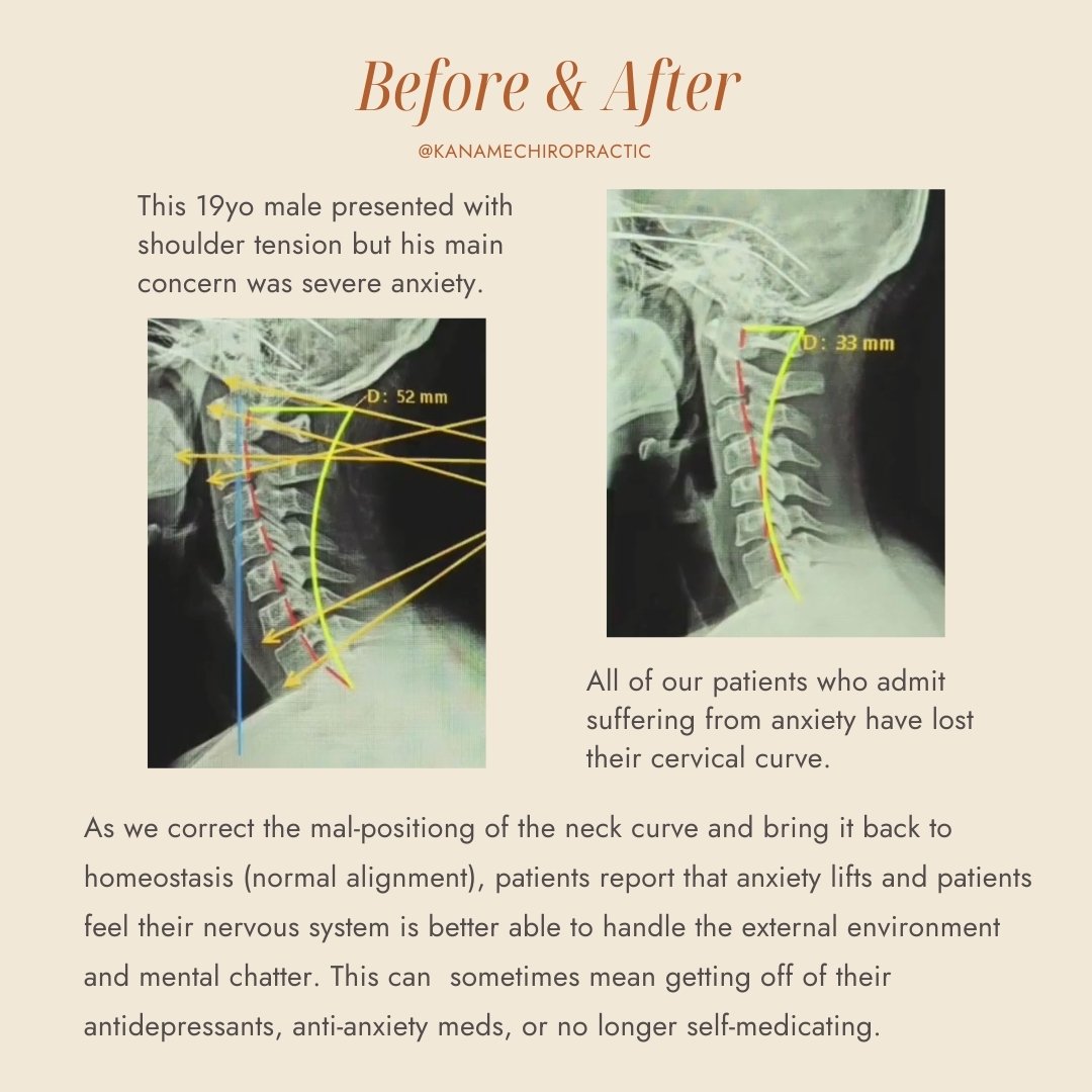 A lot of us can probably relate to this neck position with #techneck. I, Dr. Marisa Sum, am one of these people. If physiological science weren't enough, I have my own anecdotal story to share.

I have suffered from anxiety and depression on and off 