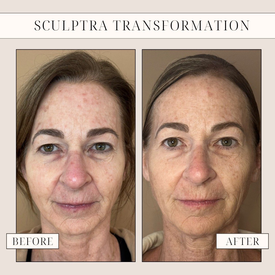 Before &amp; after a Sculptra session! 💉 Gift mom the amazing effects of Sculptra this Mother's Day with 10% off gift cards at Glow by K2! 💐⁠
⁠
Sculptra is a facial injectable treatment that helps stimulate the skin&rsquo;s own natural collagen pro
