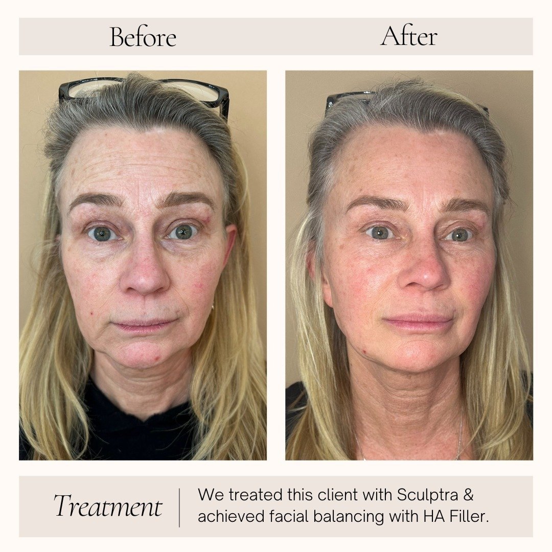 Amazing skin transformation for this client! Here we used treatments of Sculptra and HA filler to achieve facial balancing and a more refreshed look. Her skin is looking so radiant! This is why we call Sculptra our &quot;liquid face lift&quot;! 😉💉⁠