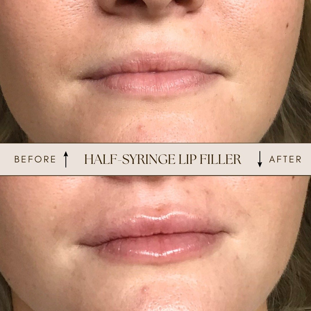 It's time to get your perfect summer pout! 💉👄 And, now is the best time while we are offering $80 OFF ALL filler! (For a limited time only!)⁠
⁠
May Specials: ⁠
🌸 10% OFF all gift certificates. Purchased in shop or online! ⁠
🌸 20% OFF all sunscree