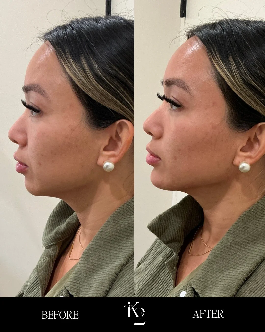 Defined. Balanced. Snatched. 💉⁠
⁠
Love this before &amp; after of this gorgeous client's chin + jawline filler! These results are just.. Chef's kiss. 💋 Book your appointment today!⁠
⁠
📍 4024 Shelbyville Rd, Louisville, KY 40207⁠
📞 (502) 420-8330⁠