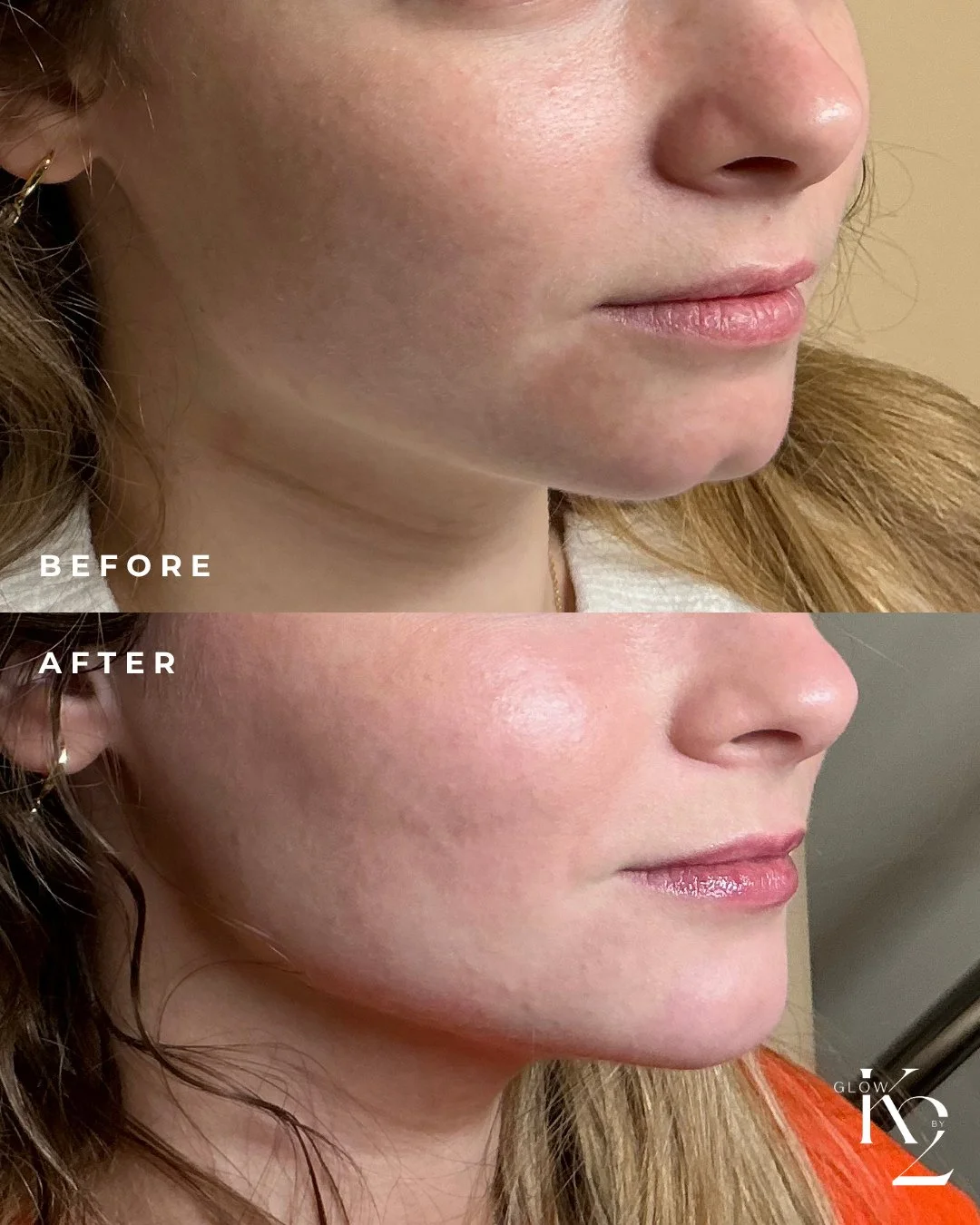 This chin filler before + after? No notes. 🤌✨
Filler is buy 1, get 1 for 31% OFF next Friday only! Call or come in to purchase and use by 12/31. 💉 
Thursday, October 30th 
💉 $3.66/Unit Dysport for New Clients - Must be done on 10/30!
💉 $3