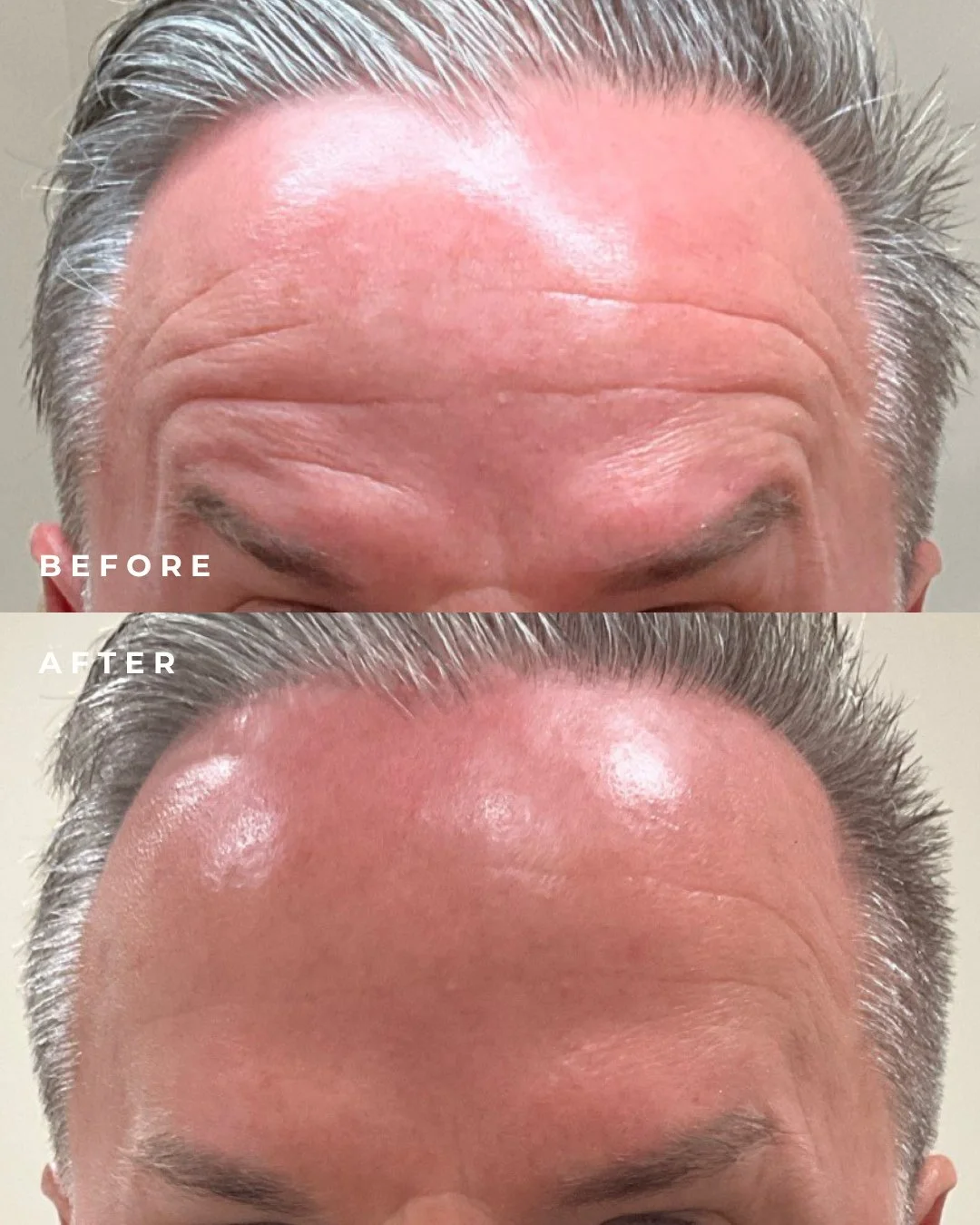 Dyport Before &amp; After: Smooth moves only. 💉✨ ⁠
⁠
Dysport helps relax fine lines for a softer, more refreshed look &mdash; just in time for the holidays. Book your tox appointment at Glow by K2! ⁠
⁠
📍 4024 Shelbyville Rd, Louisville, KY 40207⁠
?