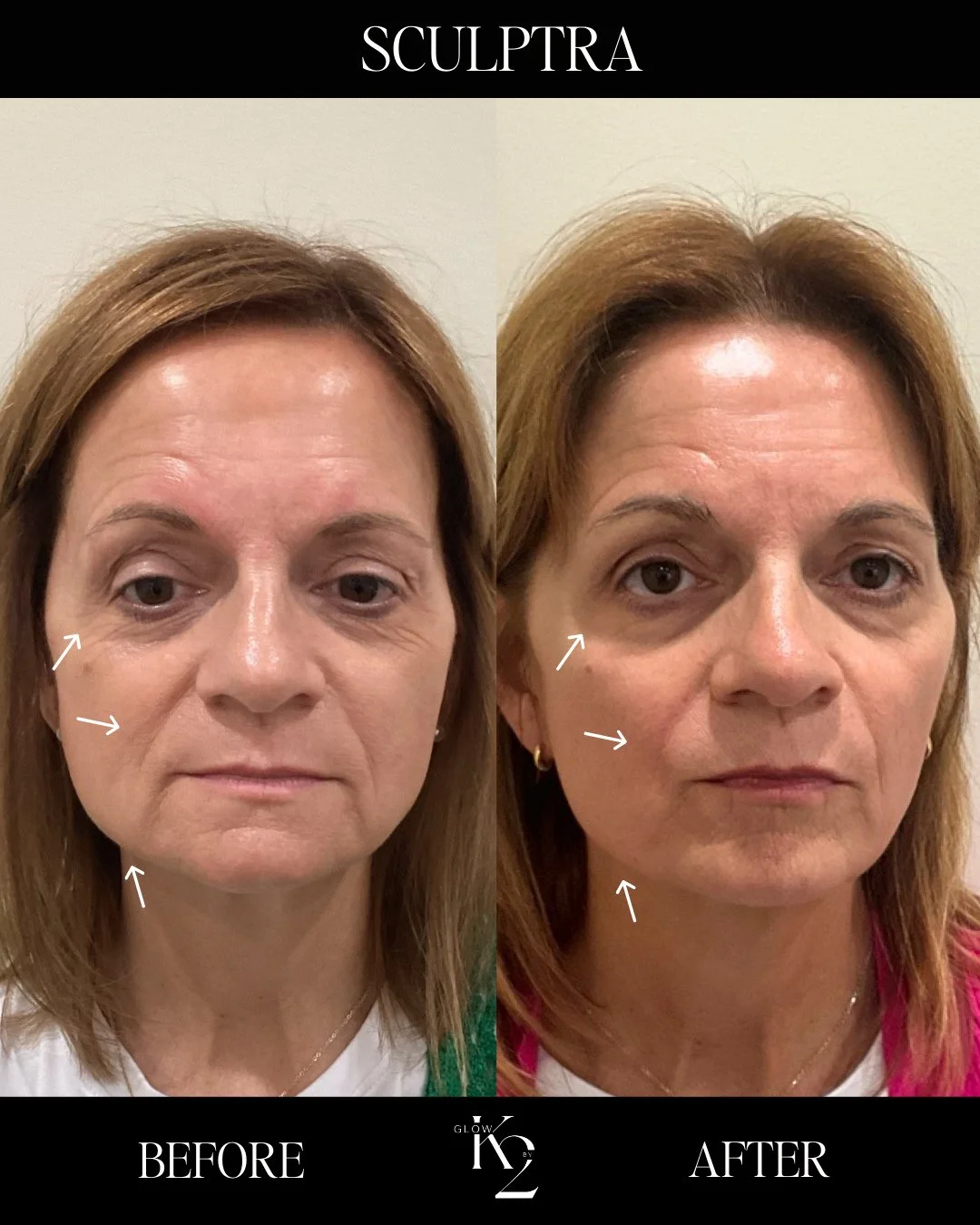Here&rsquo;s our client after her 4th vial of Sculptra! 💉⁠
⁠
Sculptra works by stimulating your body's own collagen production to gradually restore lost facial volume and smooth fine lines and wrinkles. Unlike traditional fillers, it doesn't just fi