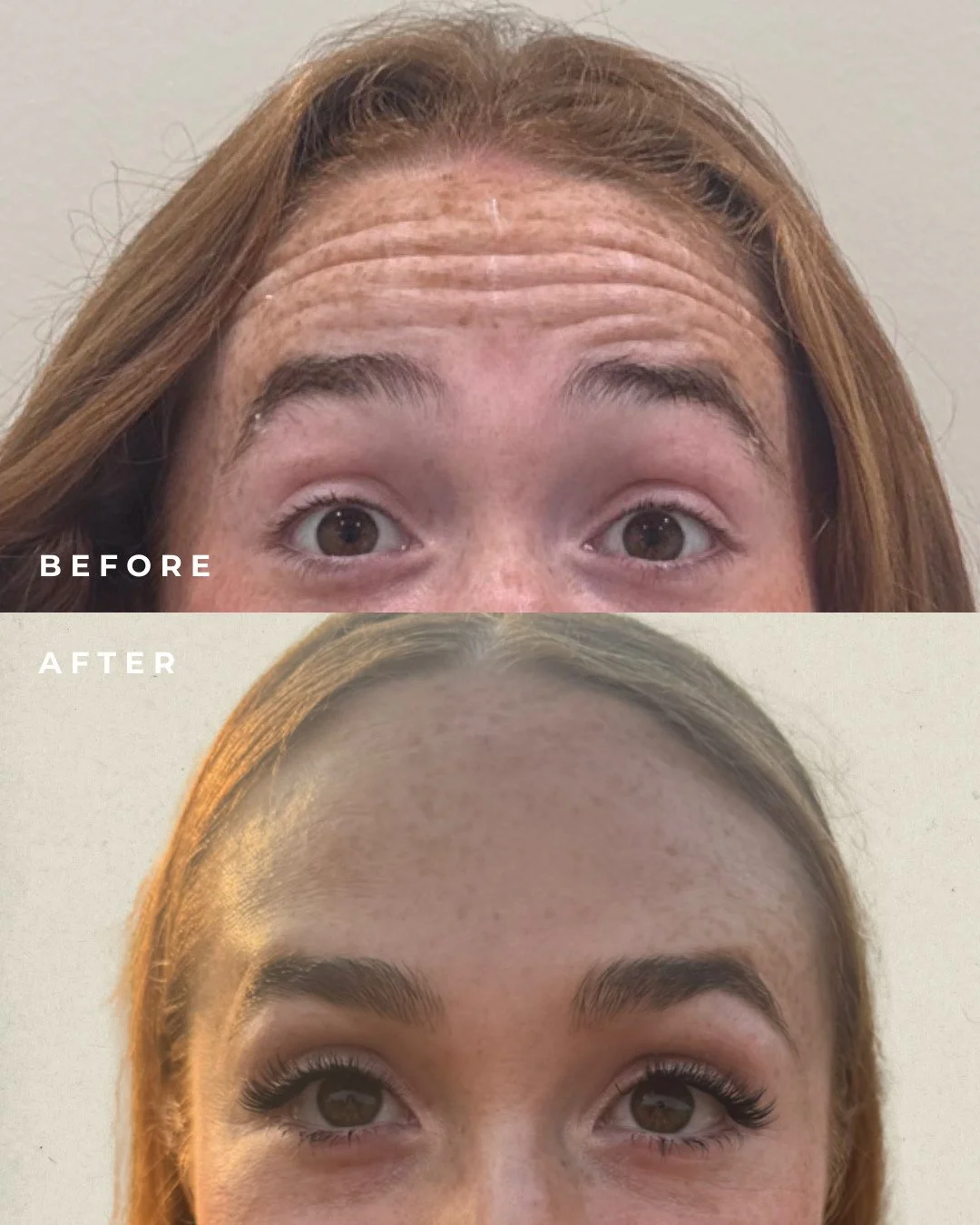 This gorgeous Dysport before + after shows how small, subtle treatments can make a big difference! 💉 ⁠
⁠
By softening movement in the forehead, Dysport helps prevent deeper wrinkles from forming keeping your skin smooth, youthful, and naturally refr