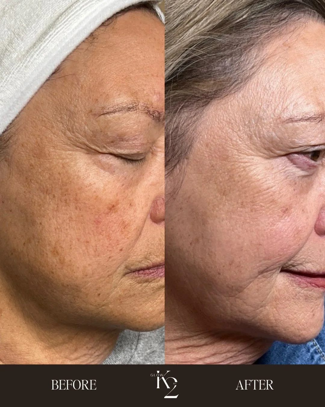 ✨ Just ONE IPL session and the results are already showing! ✨⁠
⁠
After a single IPL treatment, you can already see pigment lifting and dark spots beginning to fade. 👏 IPL works by targeting unwanted pigment and sun damage to create a brighter, more 