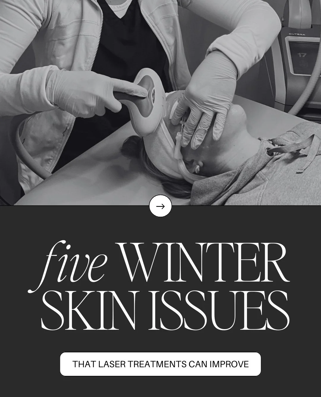 WINTER = LASER TREATMENTS 💥⁠
⁠
Why? Less sun = safer healing, better results, and lower risk of pigmentation.⁠
⁠
Laser treatments can help improve:⁠
&bull; Brown spots and sun damage.⁠
&bull; Redness and broken capillaries.⁠
&bull; Post-acne marks a