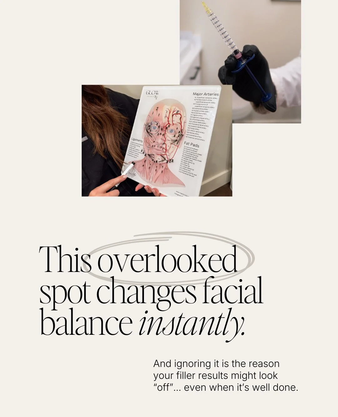 Temple filler is such an underrated treatment. 💉 ⁠
⁠
It&rsquo;s a small area, but hollow temples can make the face look more angular, pulled down, or tired, even when lips, cheeks, and skin look fresh. When treated properly, temple filler restores s