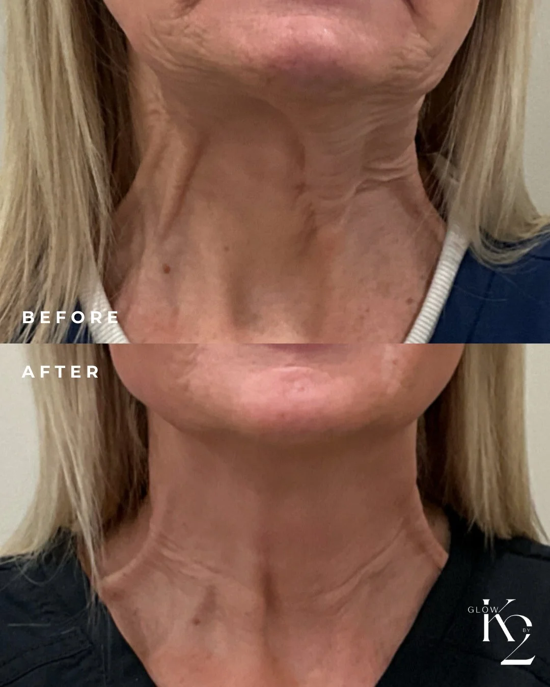 Did someone order a neck lift? 🤩 This lower face &amp; neck tox transformation is incredible and our client is loving her results! ⁠
⁠
You don't have to get surgery to achieve these results, book your tox appointment today! 💉⁠
⁠
📍 4024 Shelbyville