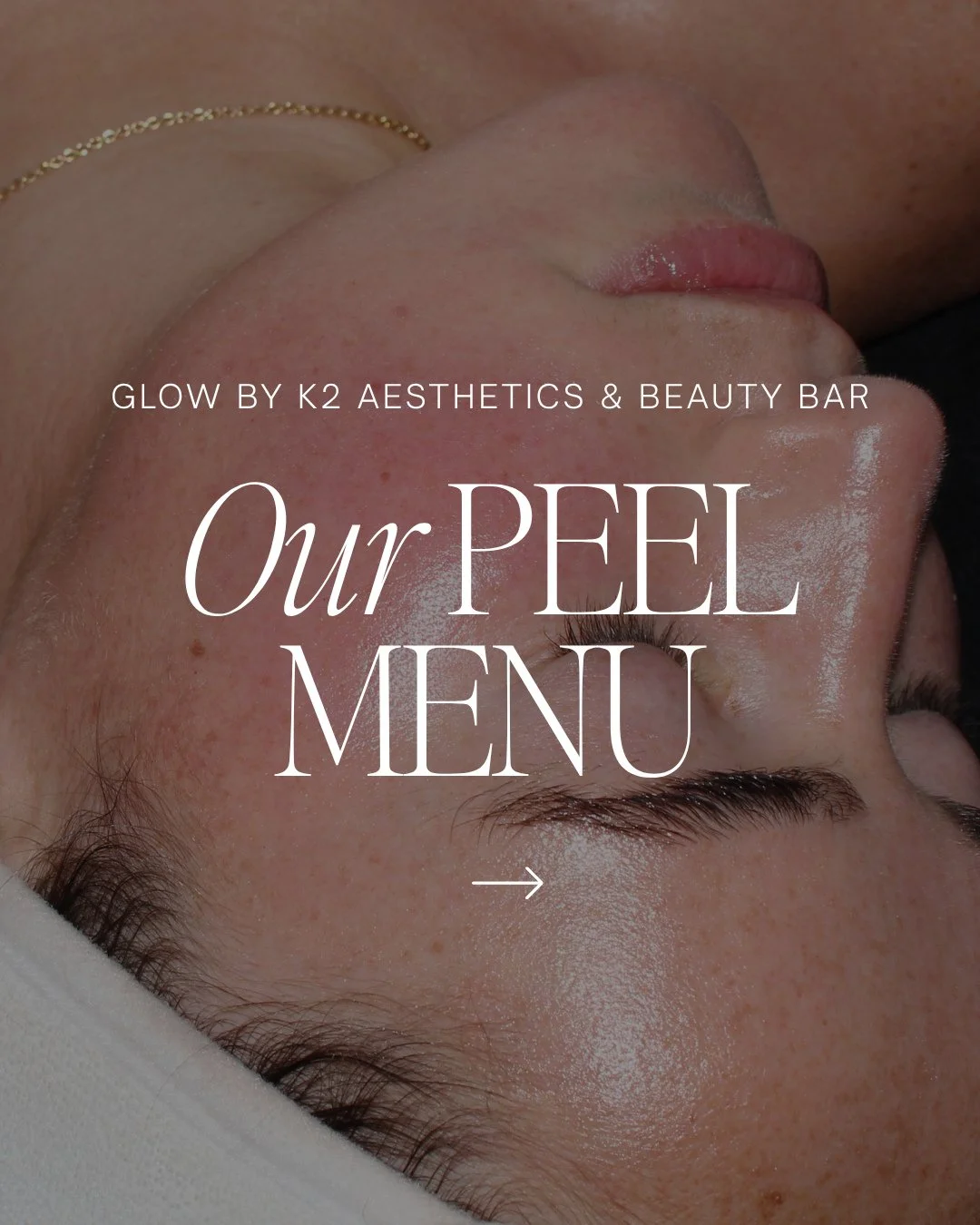 There&rsquo;s a peel for every skin concern. ✨  Enjoy 10% off ALL peels this month only! 🤩⁠
⁠
Whether you&rsquo;re dealing with pigmentation, acne, fine lines, texture, or dull skin, chemical peels are one of the best ways to reset and renew your sk