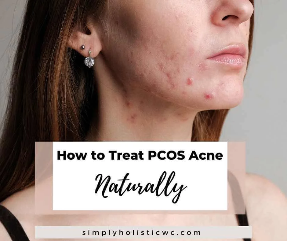 PCOS Acne What Causes it and 19 Ways to Treat it Naturally — Simply
