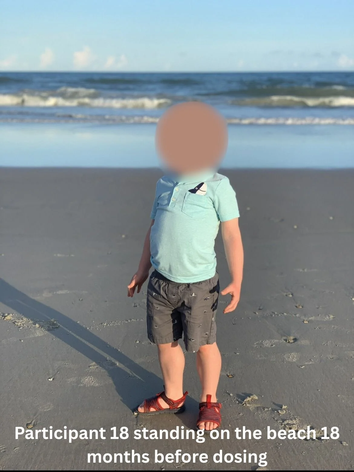 Participant 18 standing on the beach 18 months before dosing