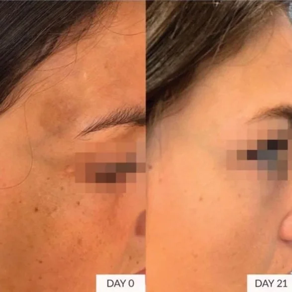Laser Facials for Black Skin