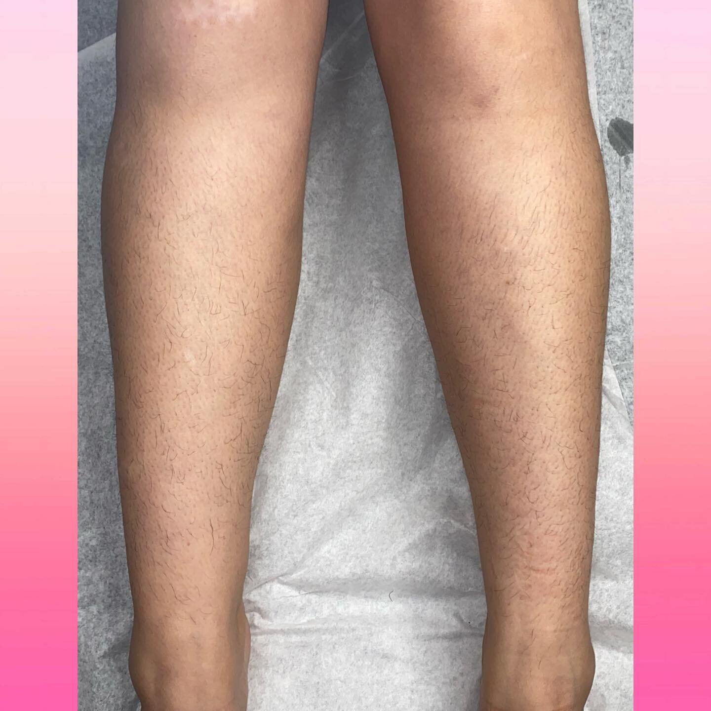Before And After Lower Leg wax. Not A Hair In Sight!🤩 #lowerlegwax #waxing #losangeles #wax