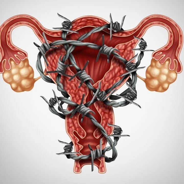A brief summary of an article in March's OG Update. Original article here:
dannytucker.net/og or link in Bio &gt; Medical Info 

Endometriosis affects around 10% of women who fall pregnant spontaneously and up to 40-50% who have difficulty getting pr