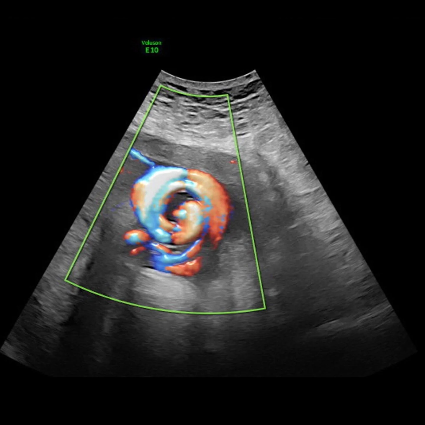 Cyclone sign: umbilical cord true knot. Have you ever seen one? True umbilical cord knots occur when the cord becomes tangled and knotted within the uterus during pregnancy. Most are found unexpectedly after birth because screening by ultrasound is n
