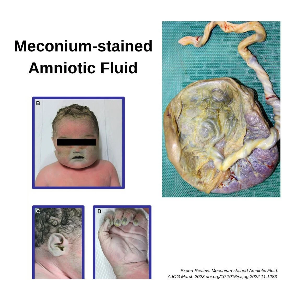 FastFacts: Meconium Amniotic Fluid. Have you heard of Meconium-Stained Amniotic Fluid (MSAF)? Here are ten facts about this condition, which occurs in up to 20% of term pregnancies:

1. The word &lsquo;meconium&rsquo; is derived from the Greek word m