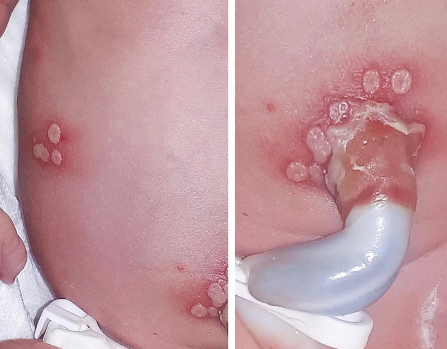 A case report from NEJM in my OG Update this month - link in bio&gt;Medical Info. A baby girl was noted to have vesicular skin lesions immediately after spontaneous preterm vaginal delivery at 32 weeks gestation. Her mother had a premature rupture of