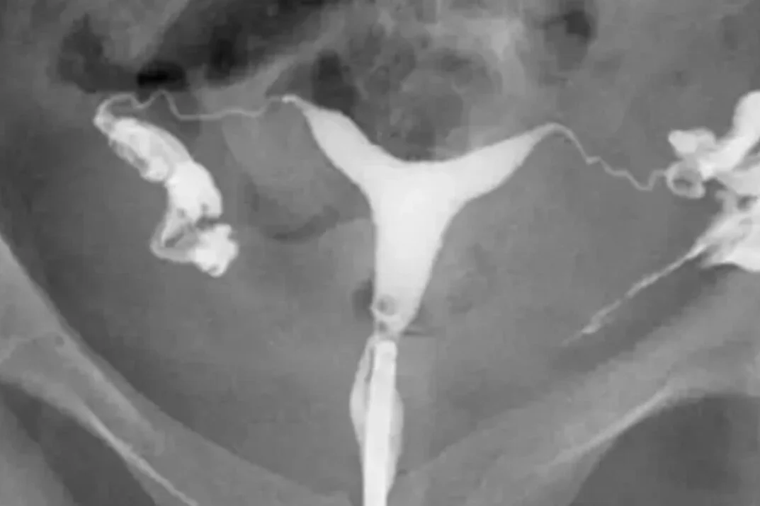 🔬 About the Hysterosalpingogram (HSG) Test. I want to do a couple of posts about non-surgical assessment of fallopian tubes, starting with HSG. I'll cover HyCoSy tomorrow.

Post any questions below!

&bull; HSG is an X-ray test that offers a view in
