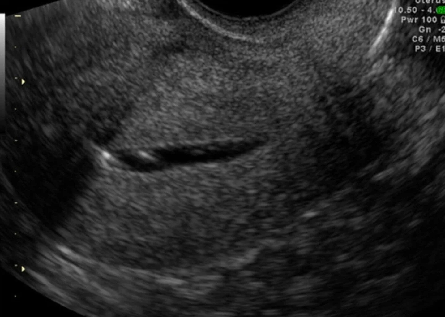Hystero-Salpingo Contrast Sonography (HyCoSy):

💡 HyCoSy is an ultrasound procedure often done to examine fertility issues, checking your fallopian tubes, uterus and other pelvic organs

What happens with HyCoSy🌀
&bull; The procedure involves intro