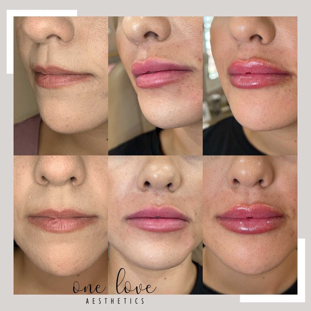 Mondays are always awesome after your appointment with me @one_love_aesthetics 

What&rsquo;s your lip type? Hydrated, Filled but natural, full, plump &amp; juicy?! You but better right?! 💕Gradual enhancement for this pretty mama!

 🫶🏻 Don&rsquo;t