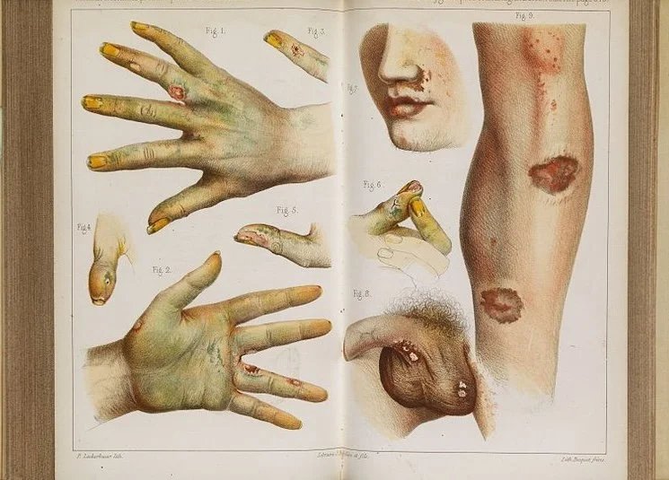 4.-accidents_caused_by_the_use_of_green_arsenic_1859_wellcome_l0075299.jpg