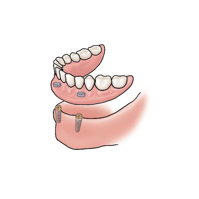 drawing of implant supported dentures
