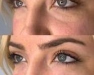 undereye filler before and after for reducing undereye hollowness