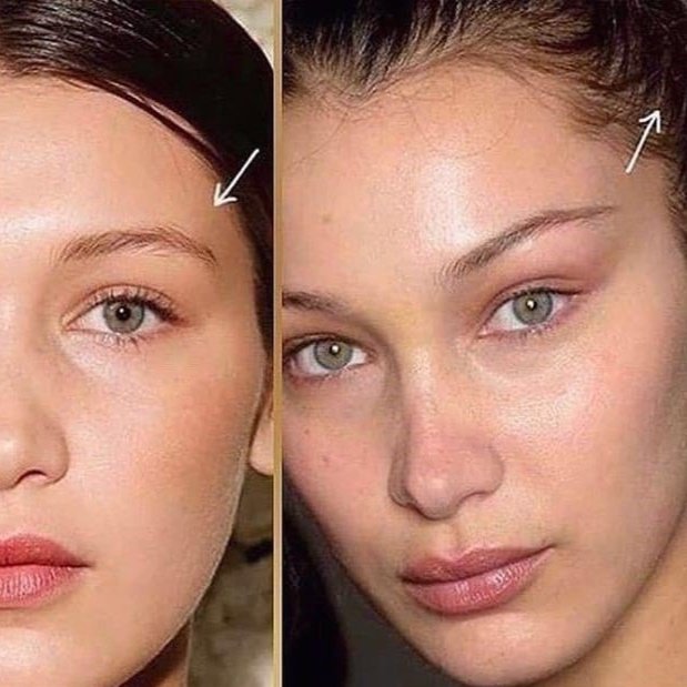 Botox brow lift