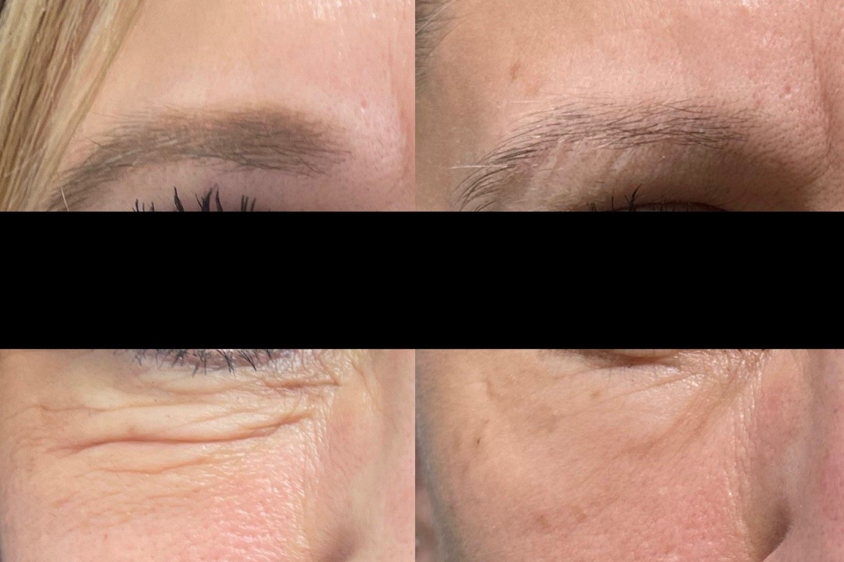 Morpheus8 beofre and after for undereye bags