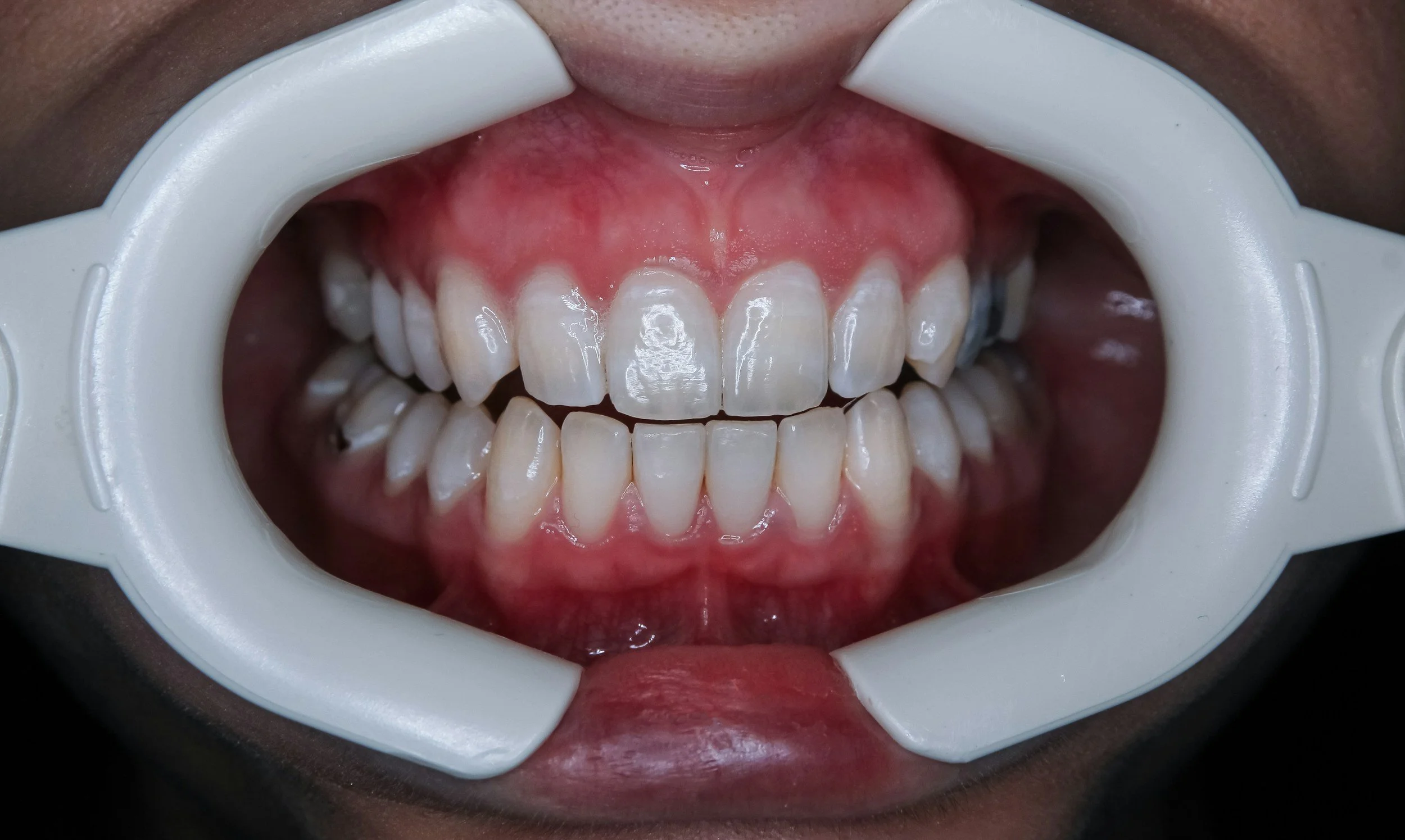 Why does the mouth heal so fast​?