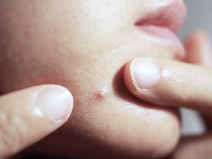 How do pimple patches work?