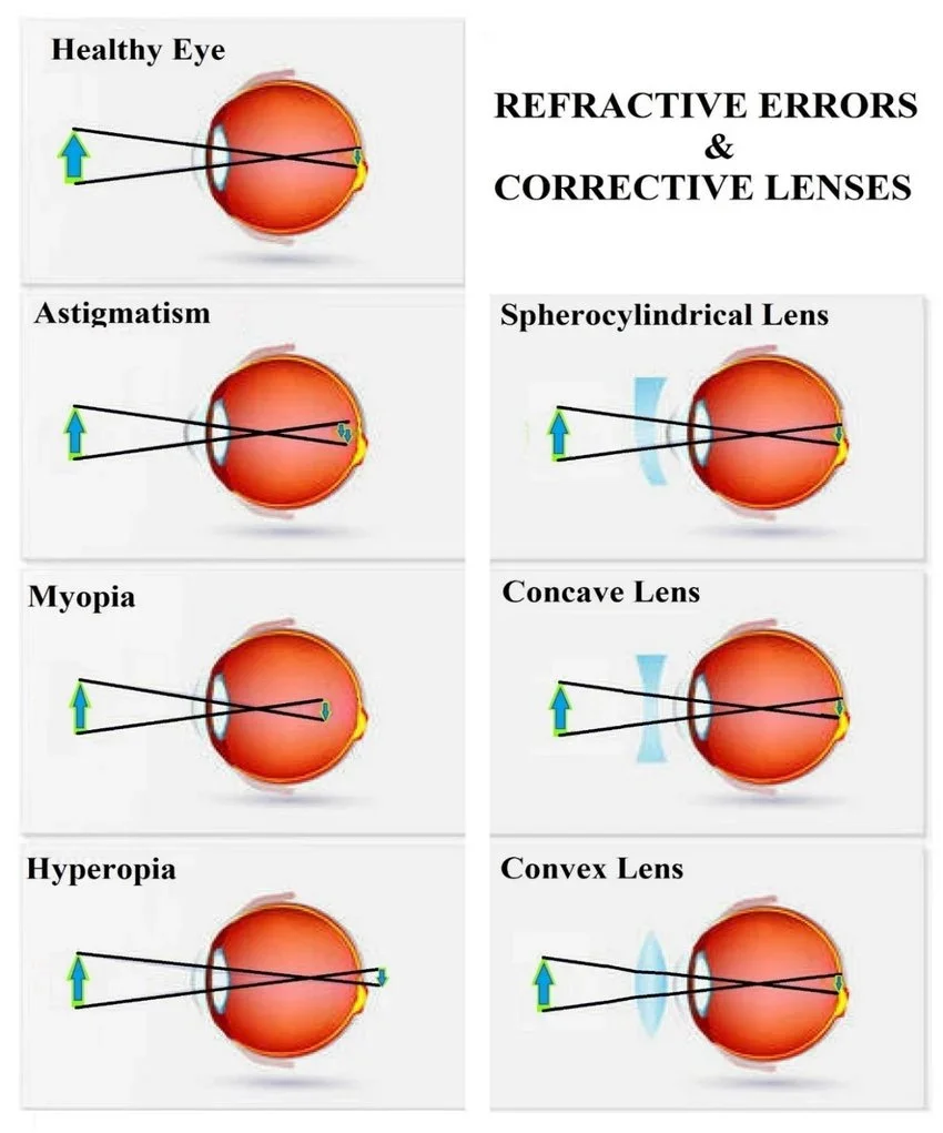 Diagram showing refractive errors and how different corrective lenses fix the errors.