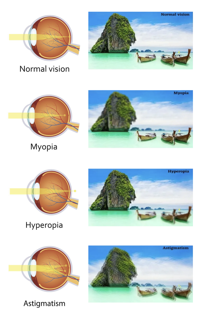 Diagram showing different refractive errors with the eye anatomy and the actual POV from the person with the error