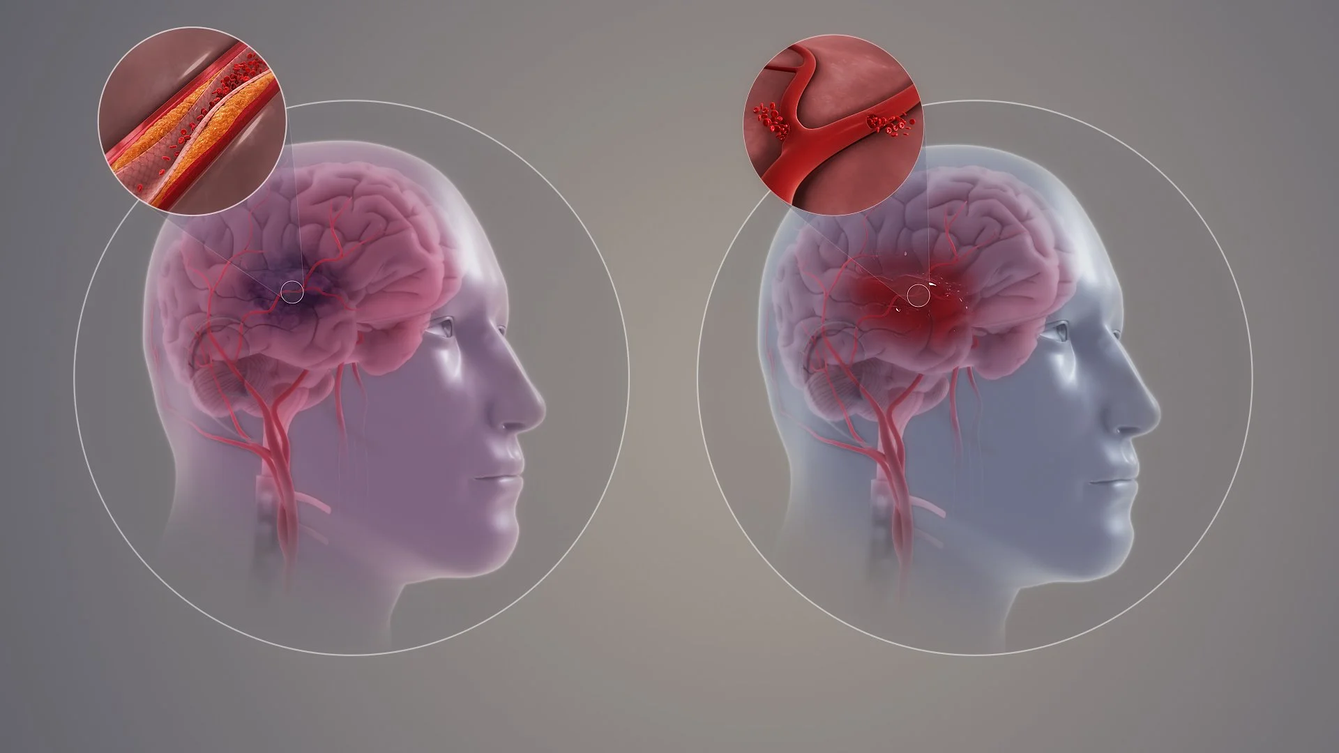 Left: An ischemic stroke is caused by a blocked blood vessel. Right: A hemorrhagic stroke is caused by a burst blood vessel.