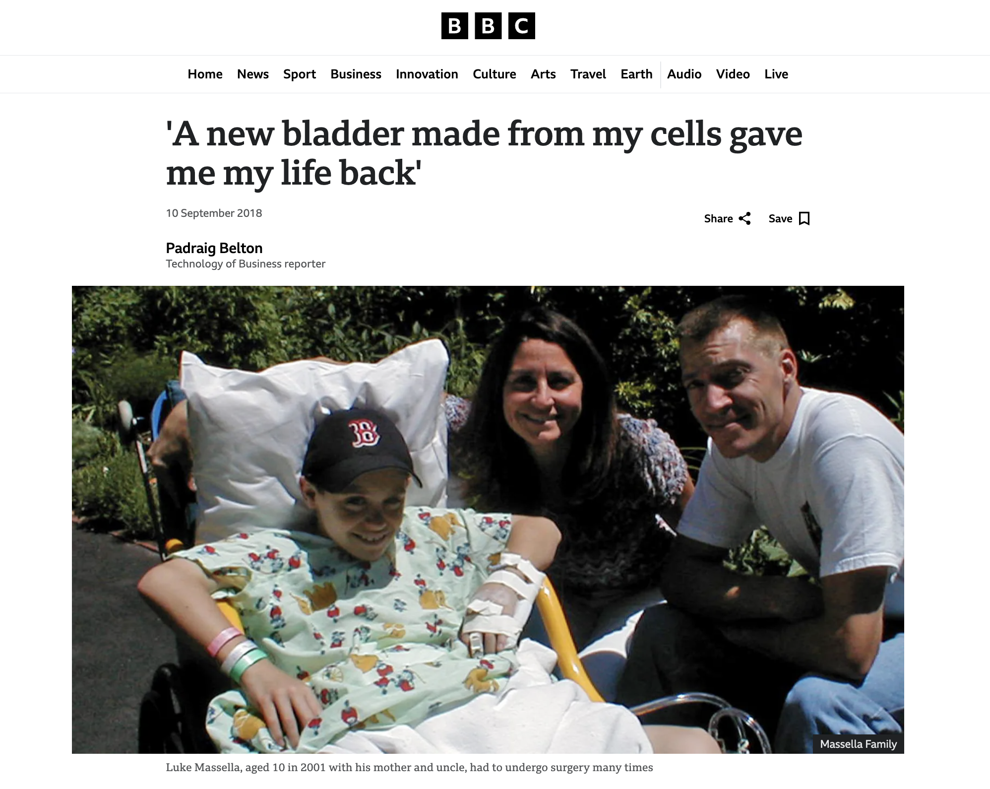 BBC news article with headline "A new bladder made from my cells gave me my life back"
