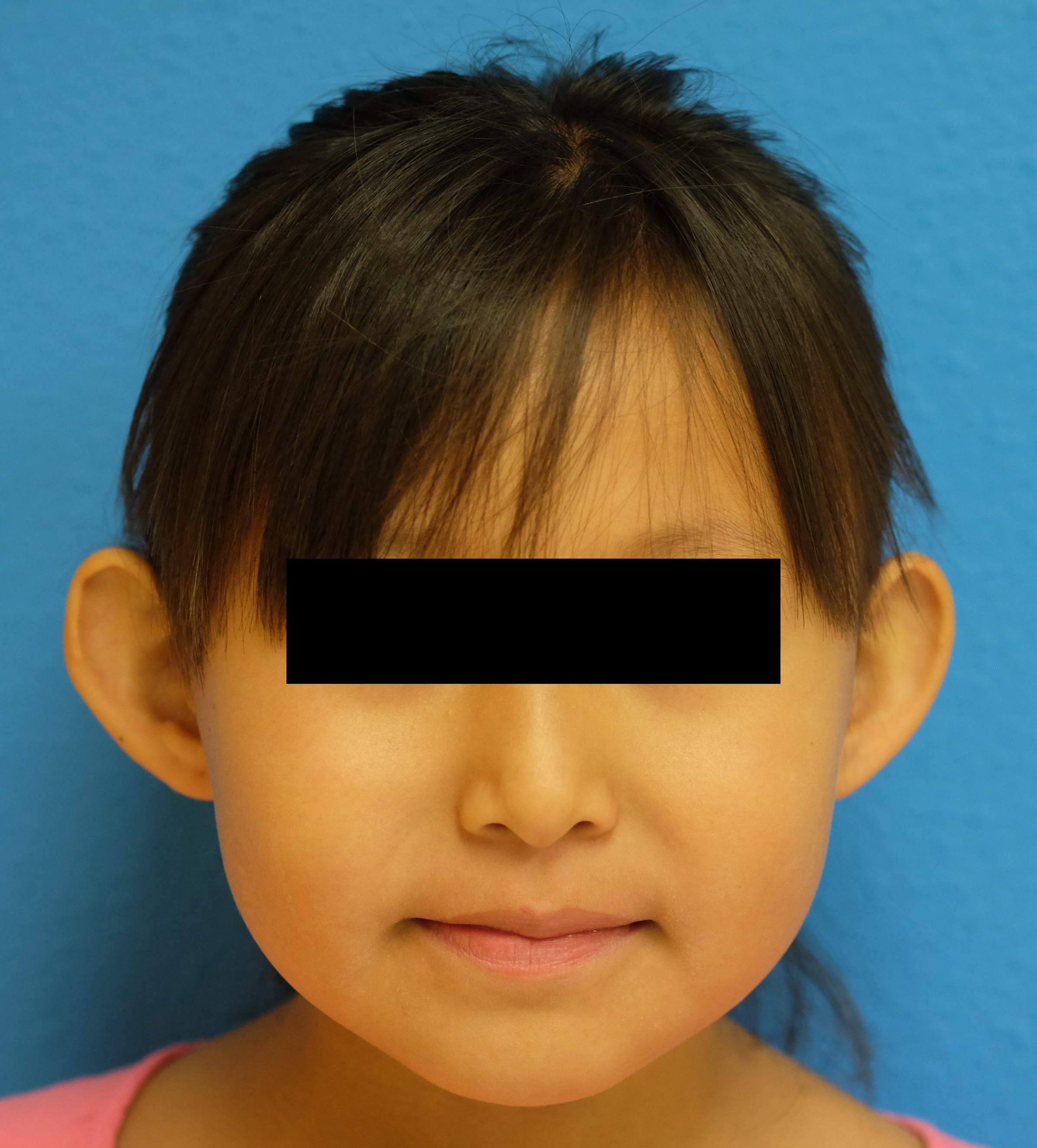 preop otoplasty.png