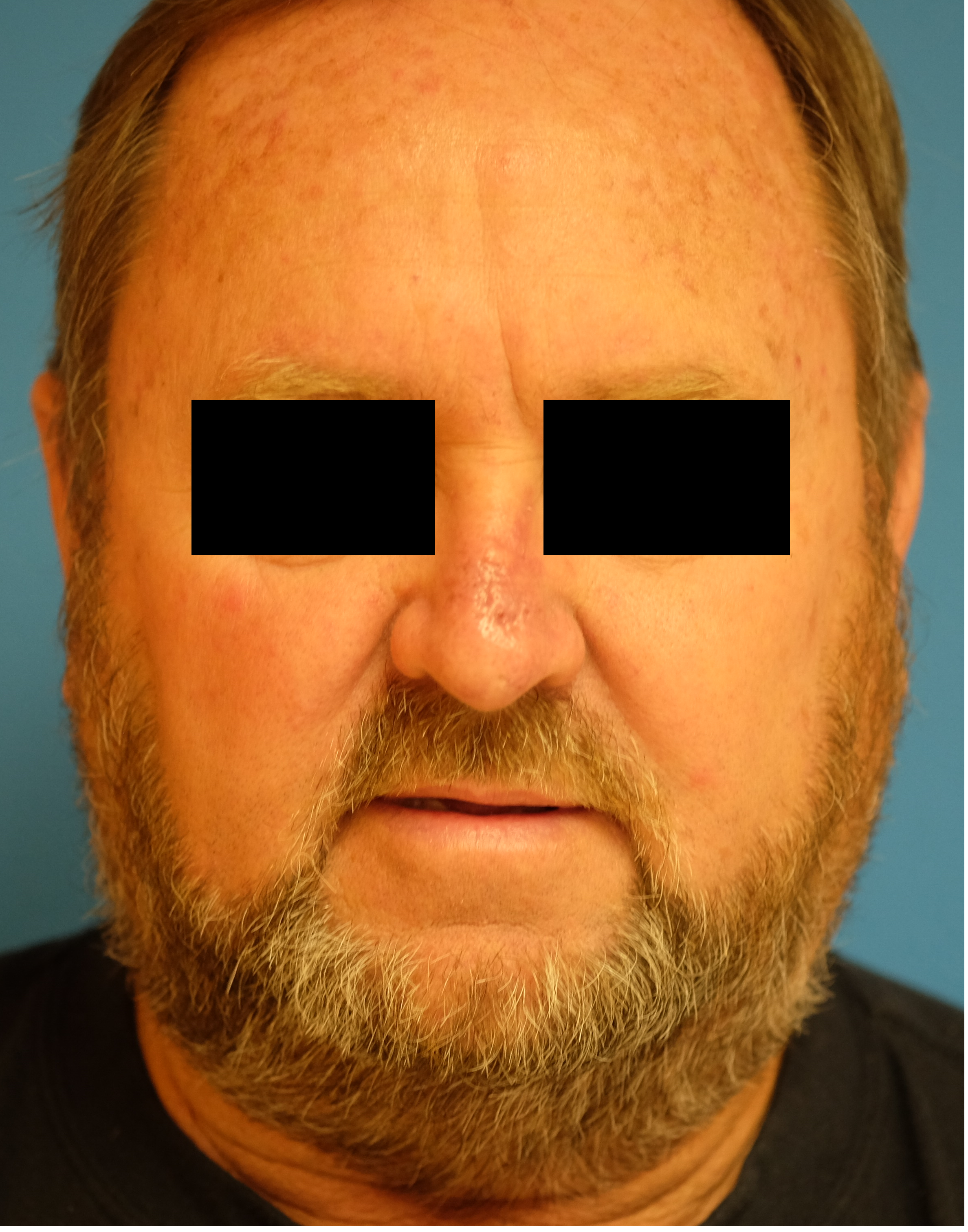 frontal post bilobe.png