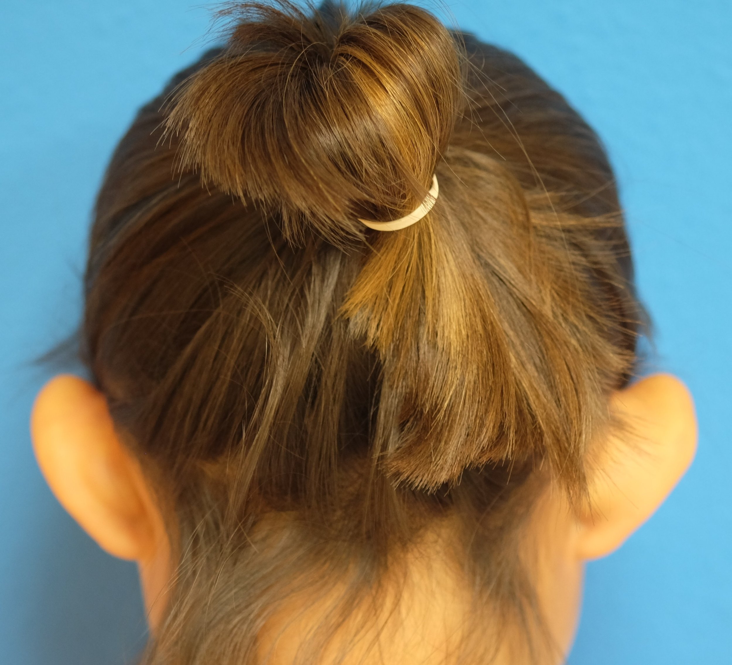 preop posterior otoplasty.jpg