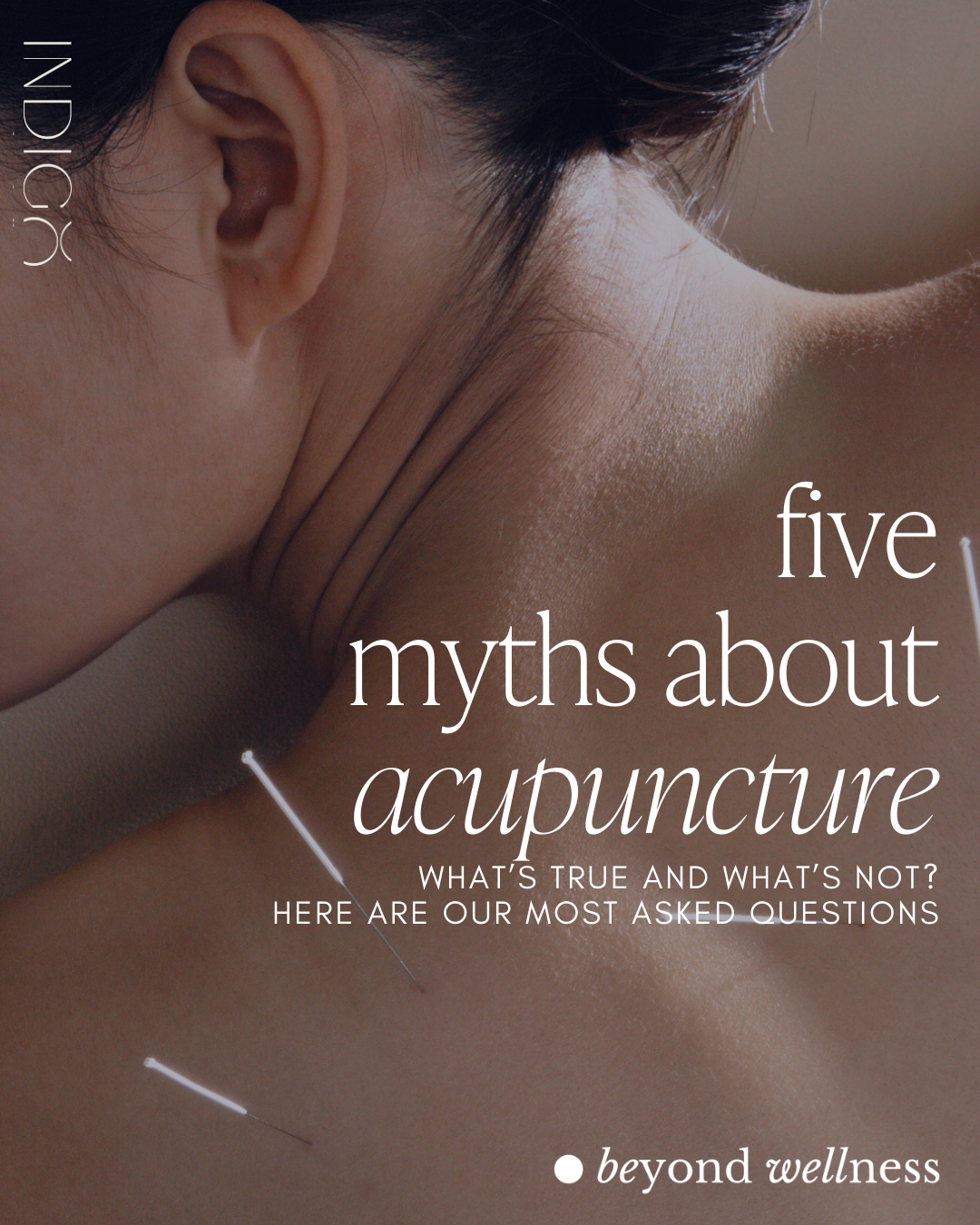 Acupuncture Mythbusting: The Truth About Acuncture