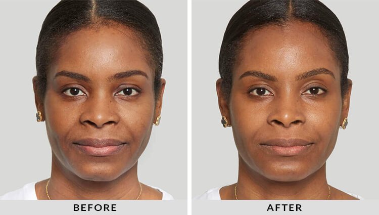 Sculptra Before and After
