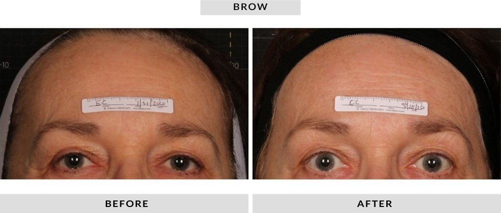 Sofwave Before and After Brow 1
