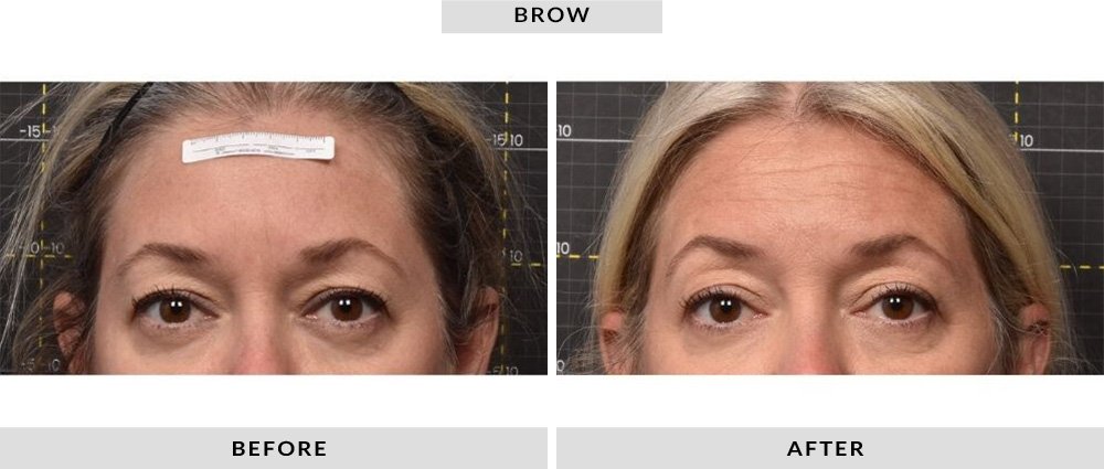 Sofwave Before and After Brow 2